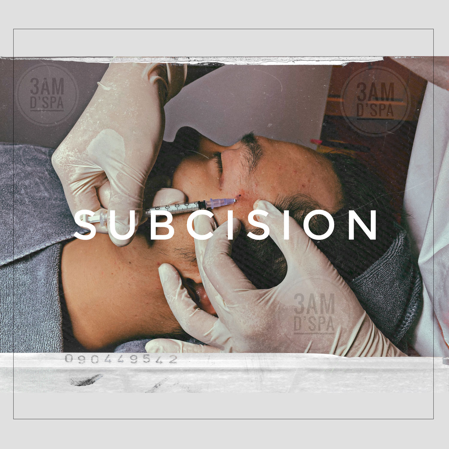 Điều trị sẹo rỗ - Subcision - Bóc tách sẹo vi điểm