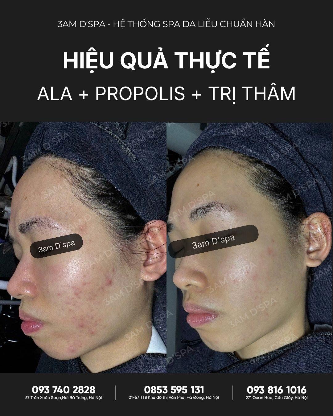 |FEEDBACK| HÀNH TRÌNH CHĂM SÓC DA SAU 5 THÁNG TẠI 3am D’Spa