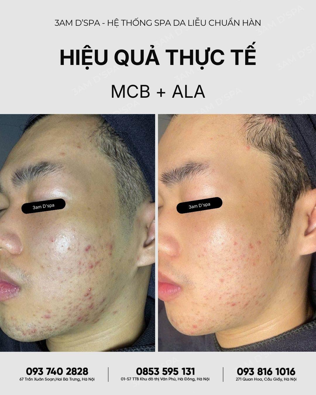 [FEEDBACK] HÀNH TRÌNH 60 NGÀY TẠM BIỆT MỤN VIÊM & BÍT TẮC