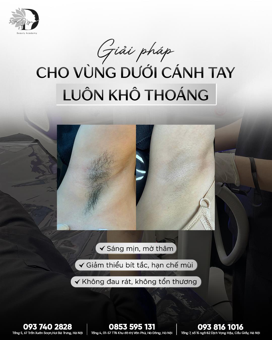 THÔNG THOÁNG VÙNG CÁNH TAY CÙNG DIODE LASER 808NM 