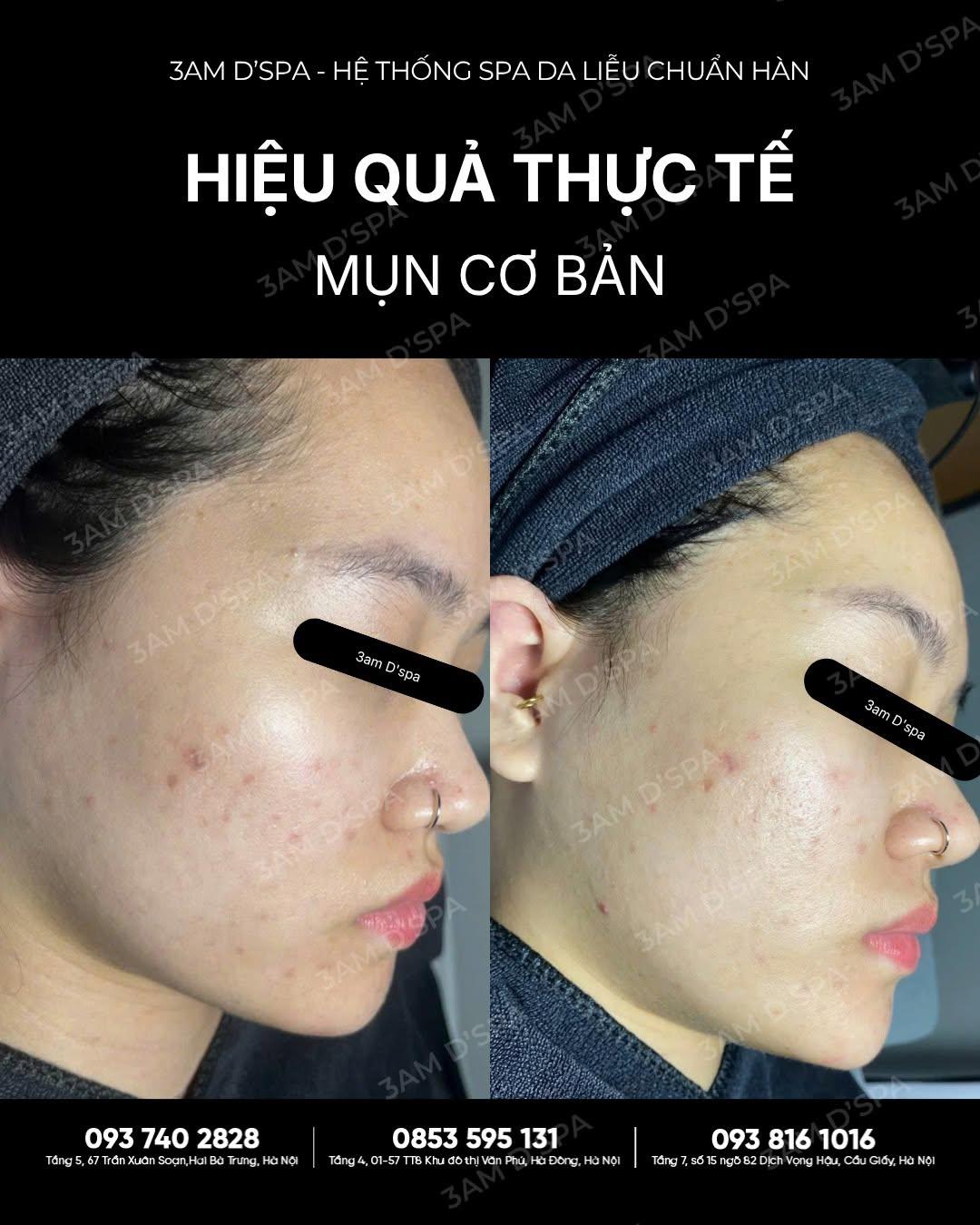 FEEDBACK KHÁCH HÀNG: DA XINH TRỞ LẠI CHỈ SAU 1 TUẦN CHĂM SÓC MỤN CƠ BẢN 
