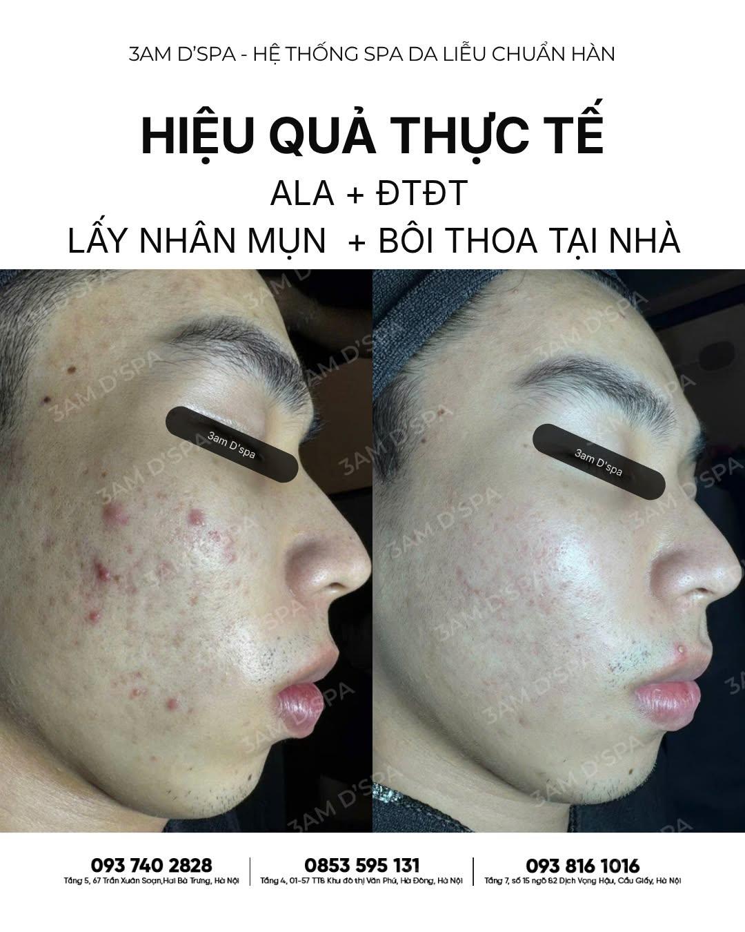 DA MỤN SƯNG NỀN DA YẾU: XIN ĐỪNG NÓNG VỘI! 