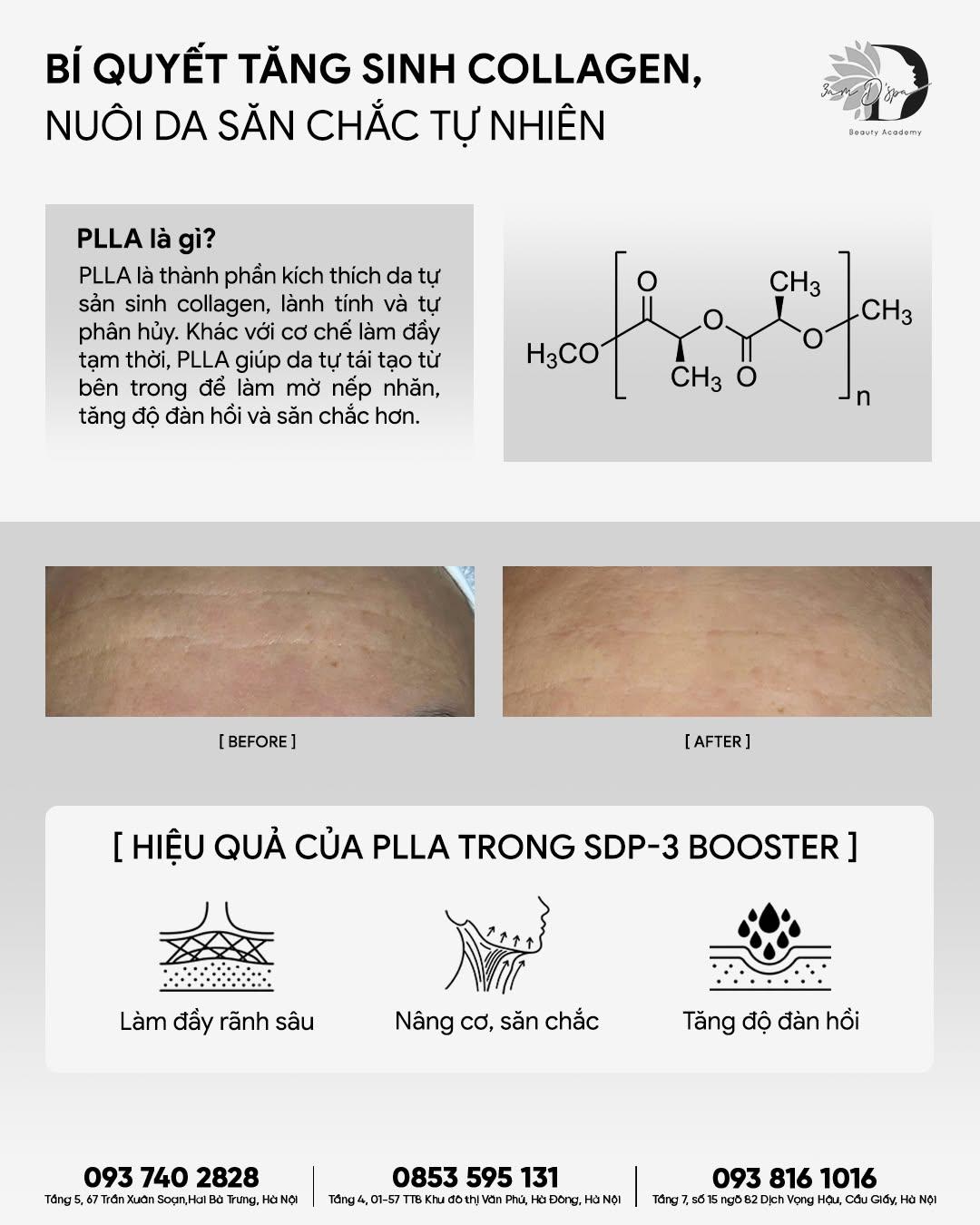 PLLA: BÍ QUYẾT TĂNG SINH COLLAGEN, NUÔI DA SĂN CHẮC TỰ NHIÊN 