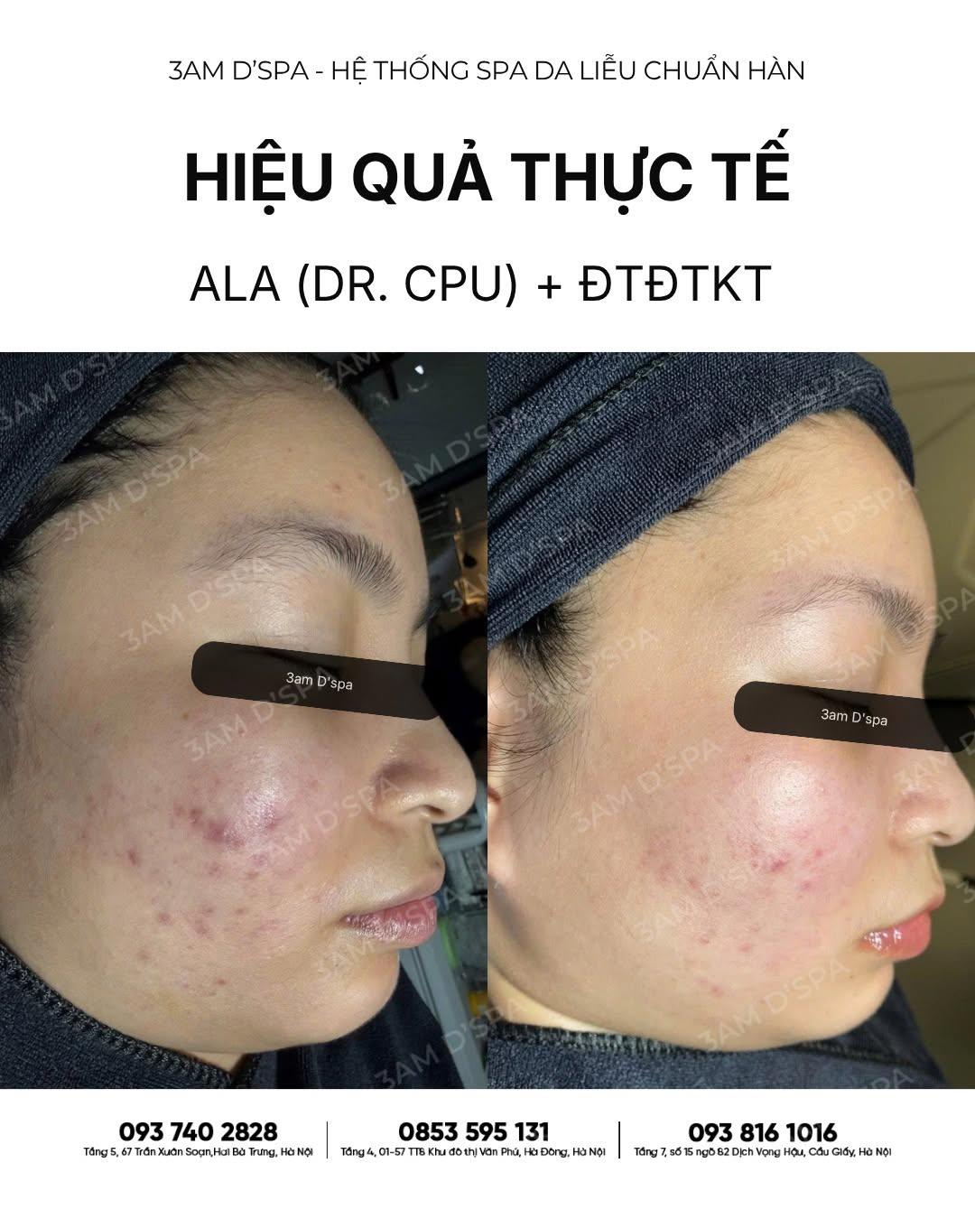 MỤN VIÊM DÀY ĐẶC: CÀNG NHỒI NHIỀU HOẠT CHẤT MẠNH, DA CÀNG DỄ BÙNG VIÊM NẶNG! 