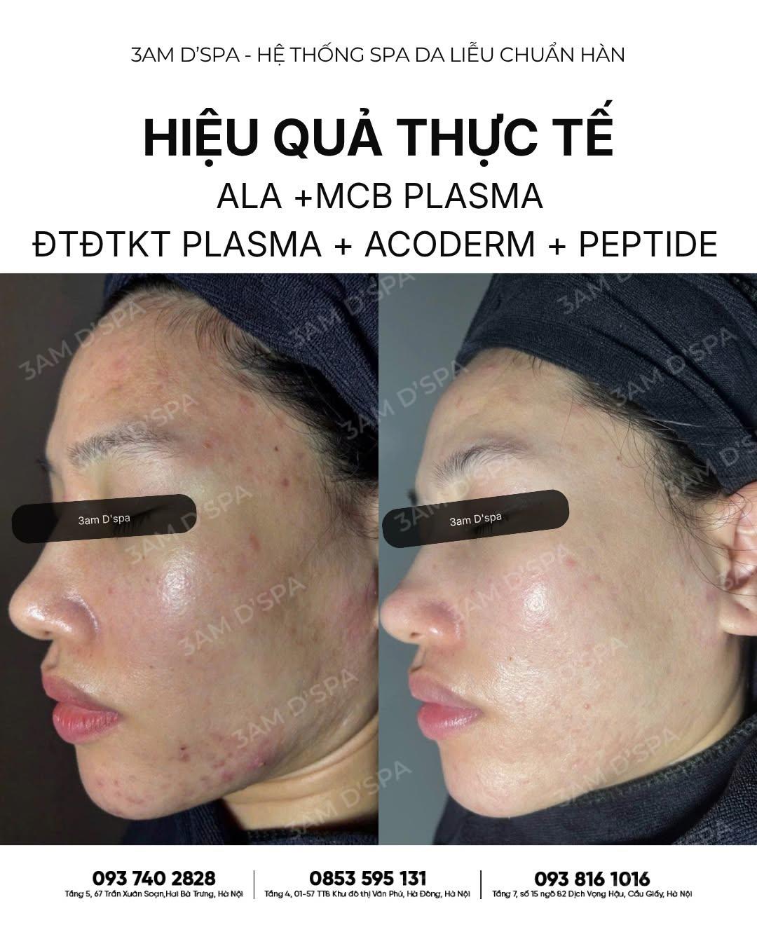 DA VỪA YẾU ĐỎ VỪA LÊN MỤN VIÊM  XỬ LÝ SAI CÁCH LÀ 